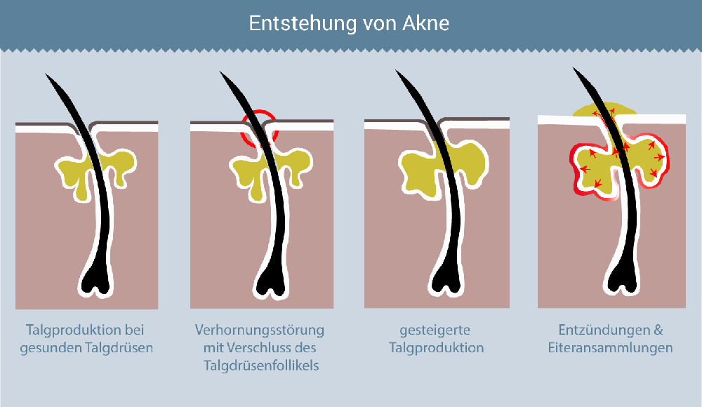 Isotretinoin gel rezeptfrei
