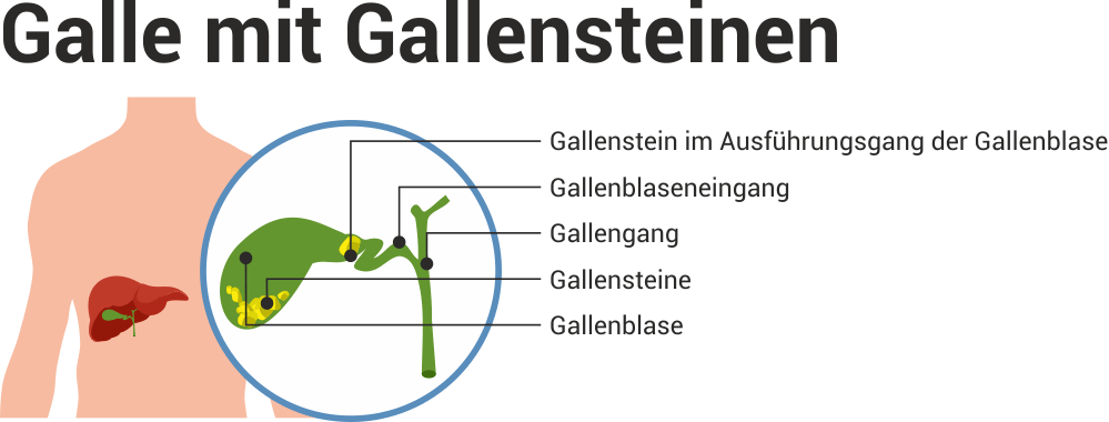 Gallensteine – Symptome, Ursachen und Therapie – Heilpraxis