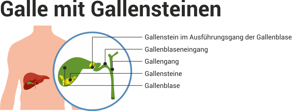 Gallenbeschwerden Symptome Ernahrung Behandlung Wolfs Apotheke Bredstedt Gallenbeschwerden Symptome Ernahrung Behandlung Wolfs Apotheke Bredstedt