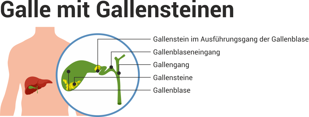 Alkohol darf man ohne trinken gallenblase Gallenstein, Alkohol