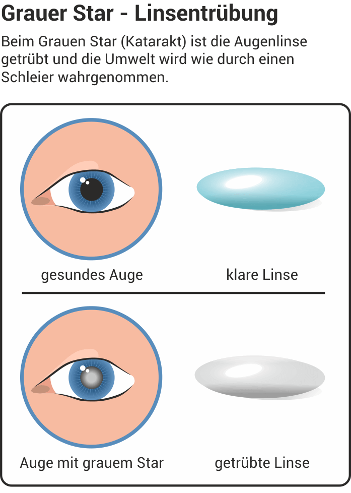Gruner Star Grauer Star Amd Symptome Behandlung Wolfs Apotheke Bredstedt Gruner Star Grauer Star Amd Symptome Behandlung Wolfs Apotheke Bredstedt