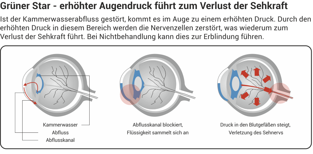 Typisch für grünen Star ist ein erhöhter Augeninnendruck