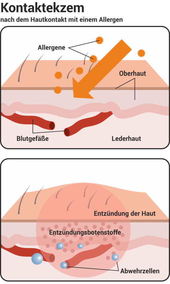 Ratgeber - Hilfe bei allergischen Hautreaktionen Adler Apotheke Aschaffenburg Ratgeber - Hilfe bei allergischen Hautreaktionen Adler Apotheke Aschaffenburg