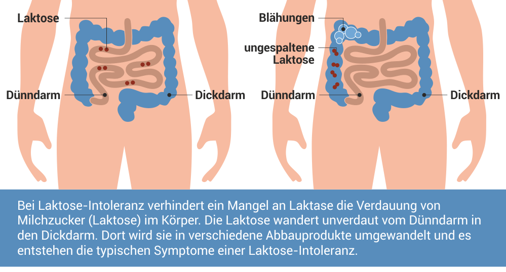Laktoseintoleranz Symptome Ernahrung Behandlung Central Apotheke Kiel Laktoseintoleranz Symptome Ernahrung Behandlung Central Apotheke Kiel