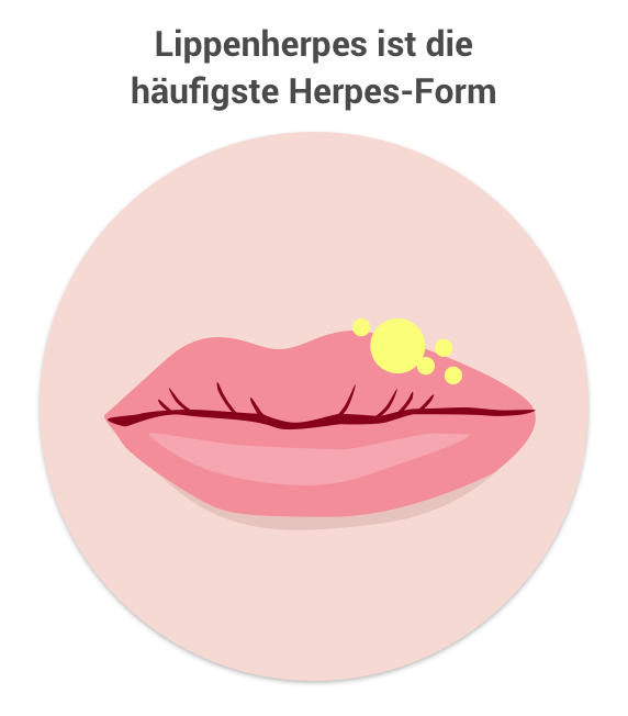 Herpes-Ratgeber | Herpes loswerden Markt Apotheke Neumünster