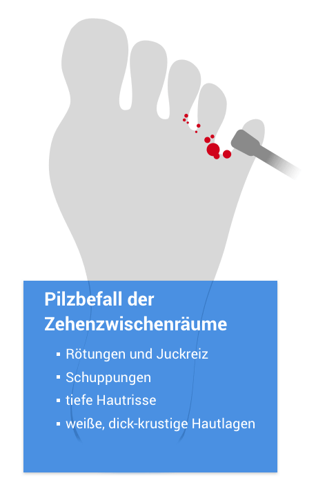 Fußpilz-Ratgeber I Hilfe & Behandlung besser gesund OHG ipunkt Apotheke ...