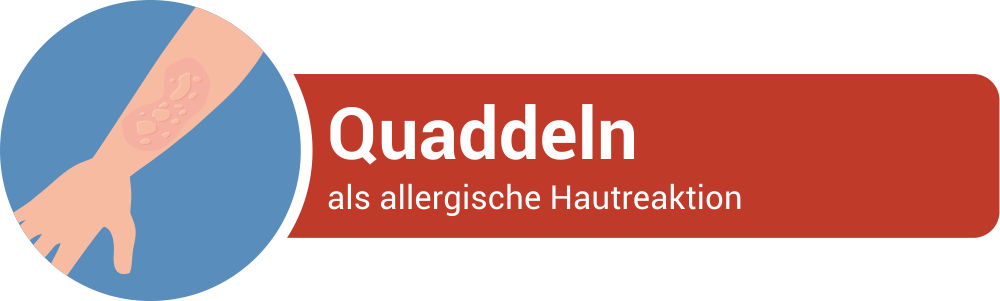 Quaddeln als Symptom einer allgerischen Hautreaktion