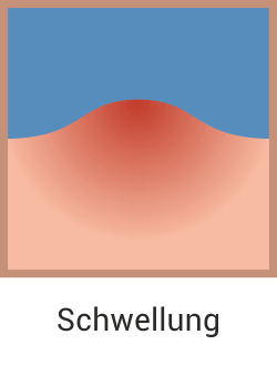 Furunkel Ursachen Erfolgreich Behandeln Vorbeugen Donn Apotheke St Michaelisdonn Furunkel Ursachen Erfolgreich Behandeln Vorbeugen Donn Apotheke St Michaelisdonn