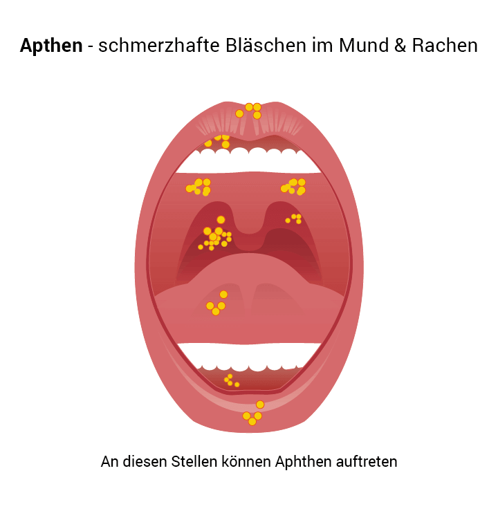Hilfe Bei Aphthen Aphthen Erkennen Behandeln Nibelungen Apotheke Braunschweig Hilfe Bei Aphthen Aphthen Erkennen Behandeln Nibelungen Apotheke Braunschweig