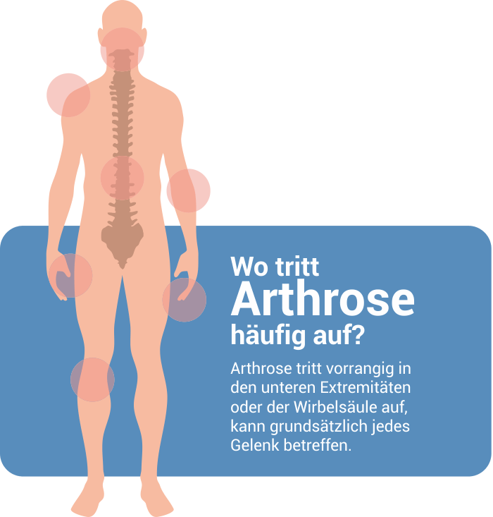 Arthrose-Ratgeber I Ernährung & Behandlung Utholm-Apotheke St. Peter-Ording