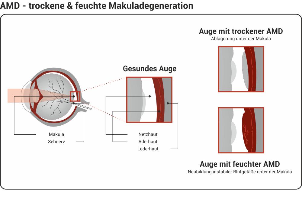 Trockene und feuchte Makuladegeneration