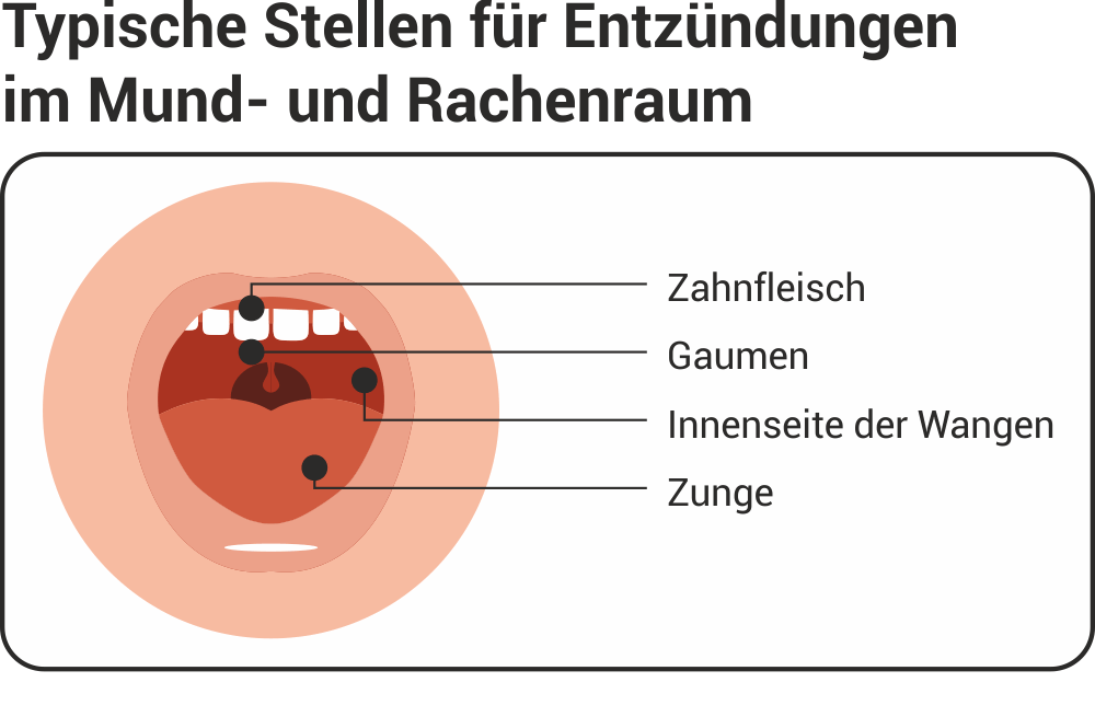 Entzündungen im Mund- und Rachenraum behandeln & vorbeugen Ahorn-Apotheke Essen