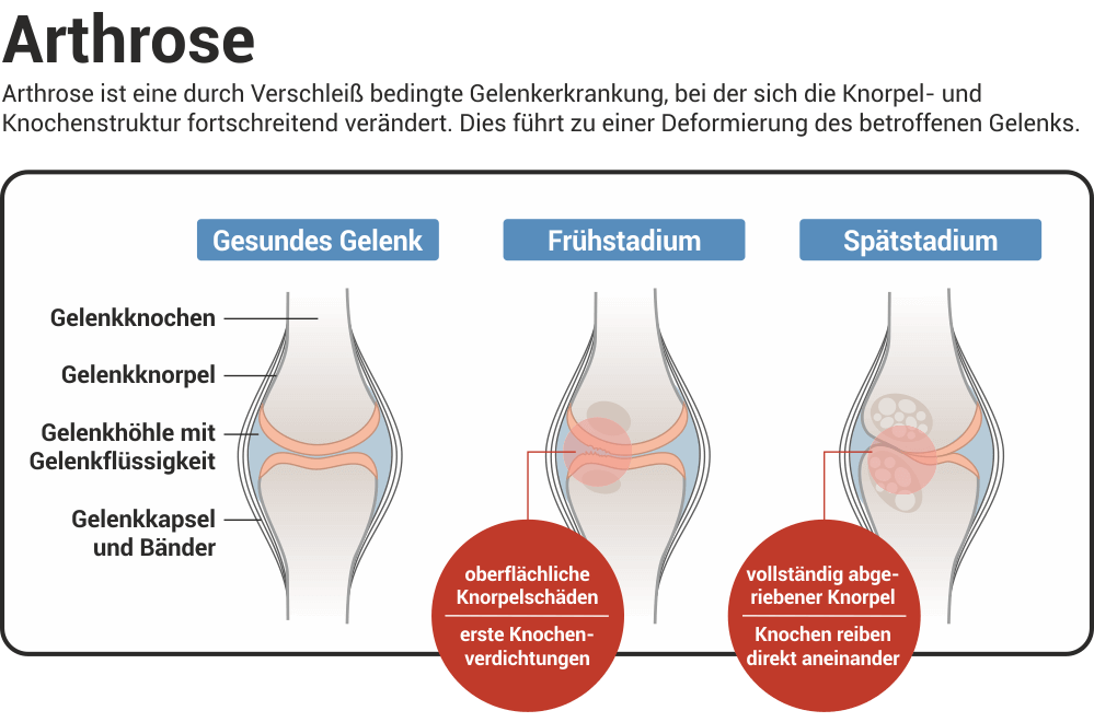 Was ist Arthrose?