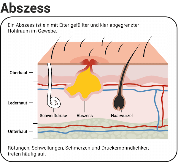 Abszess Hausmittel Abszess Offnen Abszesswunde Pflegen Medica Apotheke Kiel Abszess Hausmittel Abszess Offnen Abszesswunde Pflegen Medica Apotheke Kiel