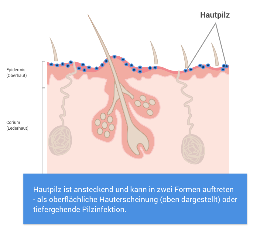 Was ist Hautpilz